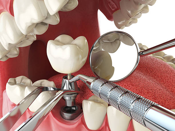 Best Emergency Tooth Extraction in San Joaquin, CA