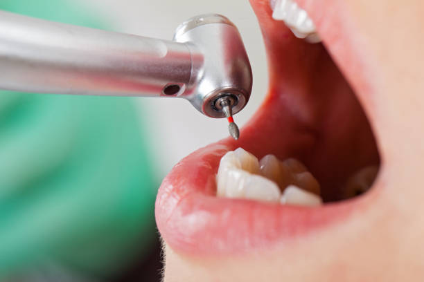Best Emergency Treatment for Dental Infections or Abscesses in San Joaquin, CA